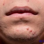 Miếng dán mụn dán trong bao lâu? có nên dán qua đêm?